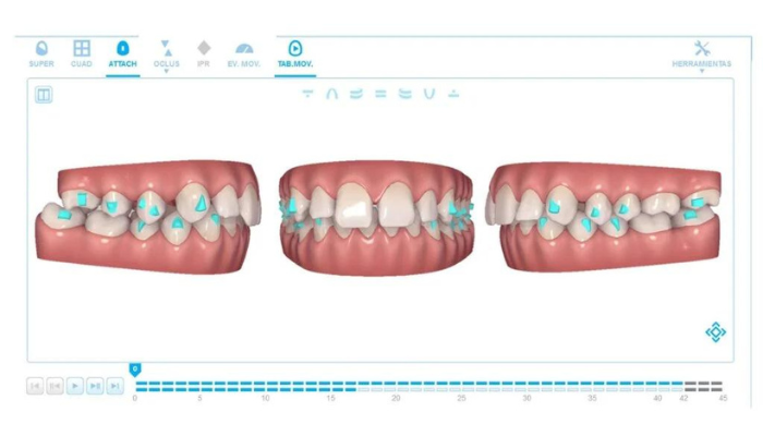 Alineadores transparentes Mesialización del molar superior con el uso de técnicas auxiliares