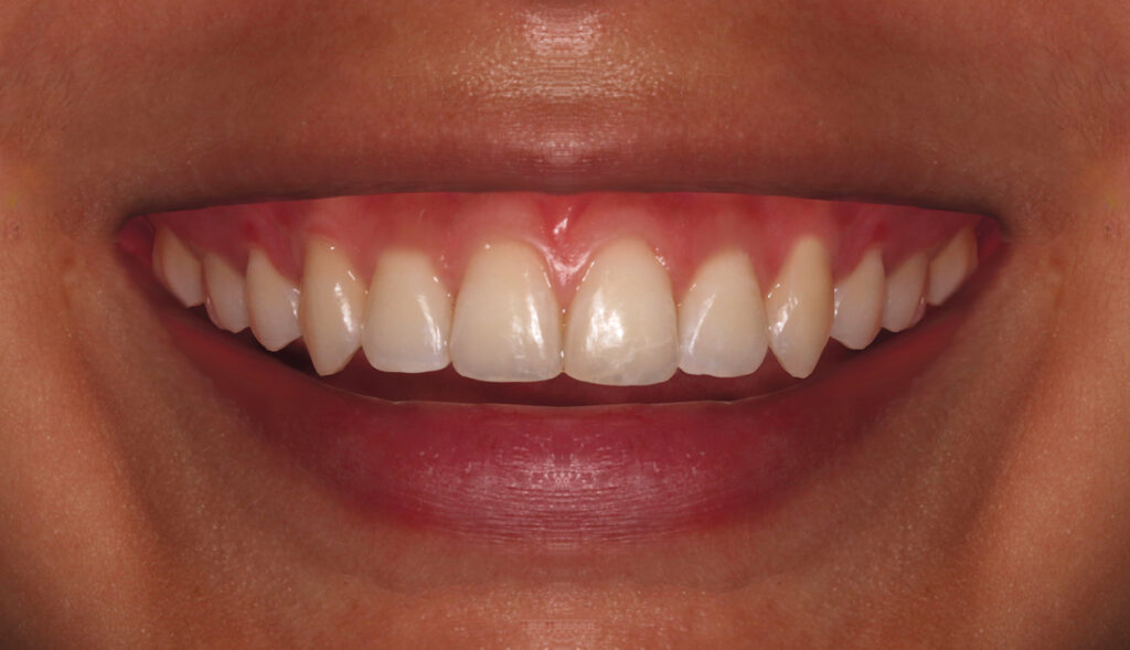 Sonrisa-gingival